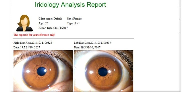 Pebble 8.2 Iridology Camera